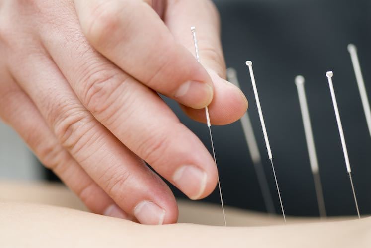 All You Need to Know About Acupuncture